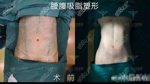 <!--<i data=20240705-sp></i>-->玉之光医疗美容吸脂对比照