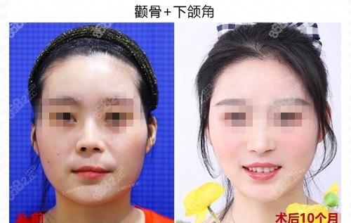 上海时光整形外科医院何晋龙医生颧骨下颌角术前术后对比图