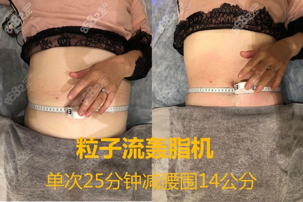 粒子流轰脂机瘦腰腹效果图