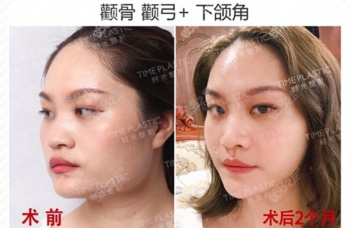 上海时光整形外科医院颧骨颧弓下颌角术前术后效果对比图展示