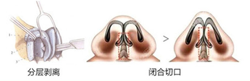 上海伯思立耳软骨鼻综合手术示意图