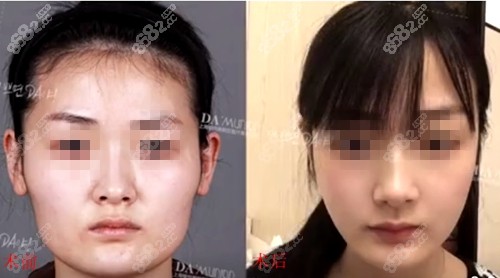 上海愉悦美联臣医疗美容医院<!--<i data=20240705-sp></i>-->下颌角磨骨术前术后对比图