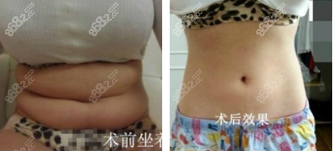 南京施尔美腰腹吸脂实例