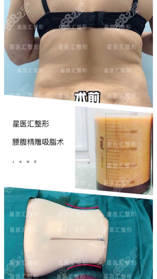 北京星医汇吸脂手术效果图