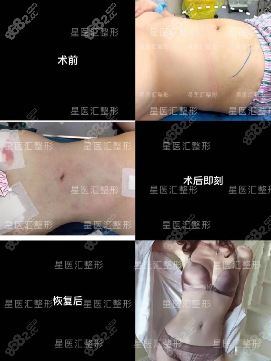 北京星医汇吸脂真人效果图