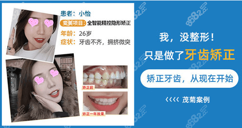 口腔好不好？牙齿隐形矫正效果参考