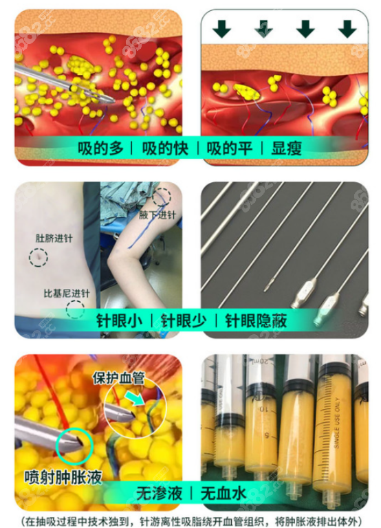 北京星医汇水动力吸脂的优势