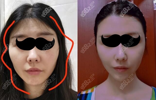 医院颧骨内推真人效果图片