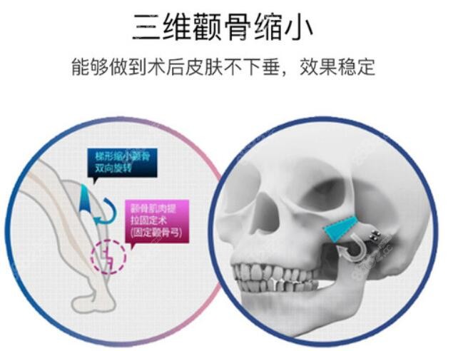 上海华美颧骨颧弓内推术技术优势