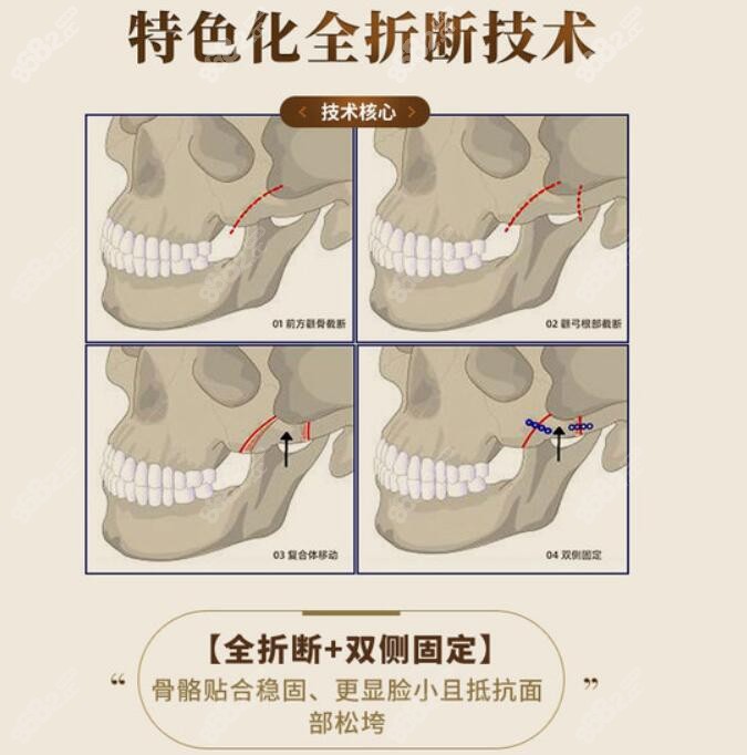 医院颧骨内推技术优势