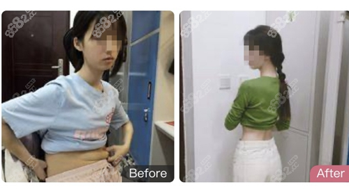 <!--<i data=20240705-sp></i>-->医疗美容腰腹部抽脂术前术后对比图