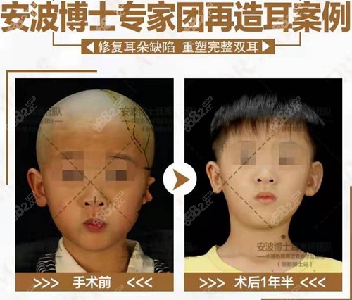 北京丽都安波小耳畸形矫正术前术后对比
