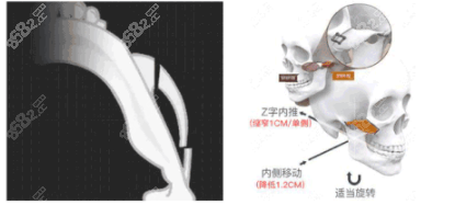 上海顴骨內(nèi)推有名的醫(yī)生