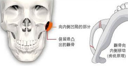 广州美恩整形6D颧骨颧弓技术