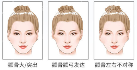 上海顴骨內(nèi)推手術(shù)價(jià)格是多少呢？