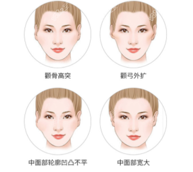 上海顴骨內(nèi)推哪家醫(yī)院好呢？