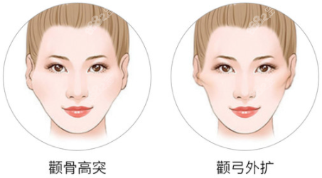 做顴骨怎么樣？