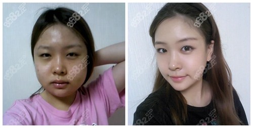 韓國(guó)WJ原辰輪廓前后對(duì)比照片 韓國(guó)WJ原辰輪廓前后對(duì)比照片