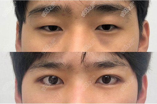 韓國(guó)珠兒麗割雙眼皮前后對(duì)比照片 韓國(guó)珠兒麗割雙眼皮前后對(duì)比照片