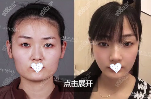 上海美联臣颧骨手术+下颌角整形效果图
