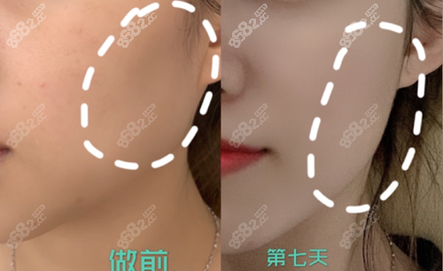 北京美莱付晓慧医生玻尿酸填充面中部前后对比效果图