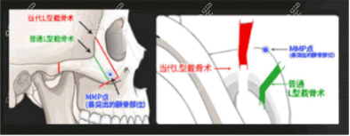 顴骨內(nèi)推技術(shù)優(yōu)勢(shì)