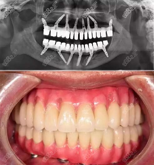 全口种植病例
