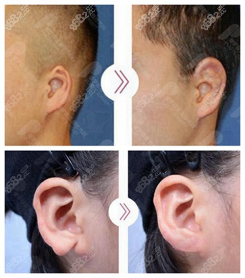 韓國(guó)普羅菲耳耳整形前后對(duì)比照片 韓國(guó)普羅菲耳耳整形前后對(duì)比照片