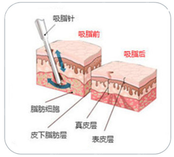 华美吸脂手术大概多少钱？