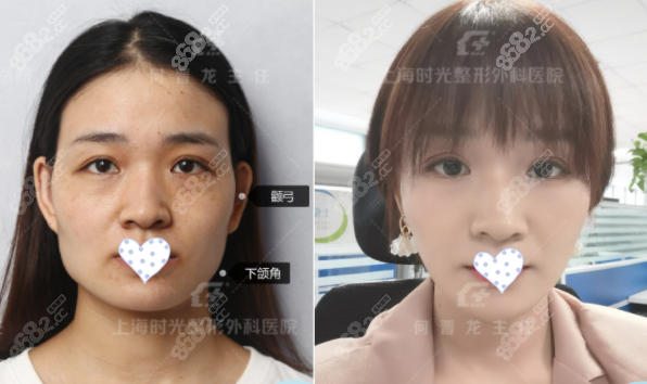 上海時(shí)光下頜角整形效果圖 上海時(shí)光下頜角整形效果圖