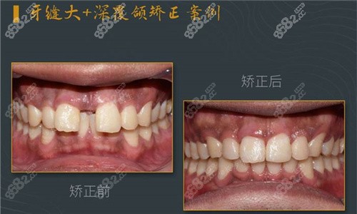 长沙牙祖口腔矫正对比