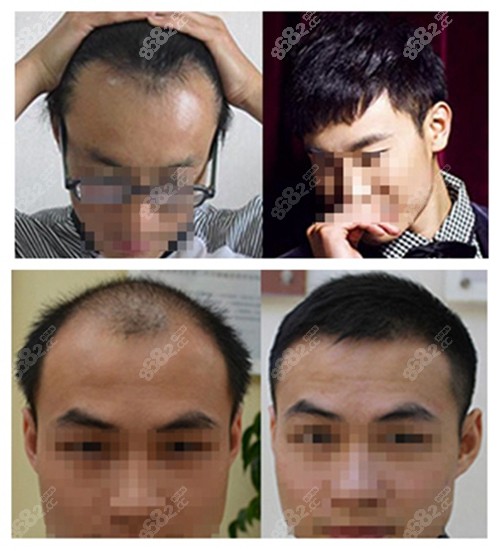 北京大麦微针植发植发前后对比照片
