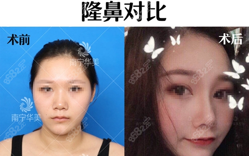 南寧華美醫(yī)療美容醫(yī)院隆鼻術前術后對比效果圖