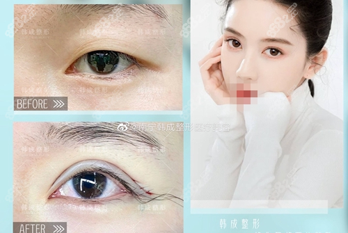 南宁韩成医疗美容双眼皮术前术后对比效果图展示