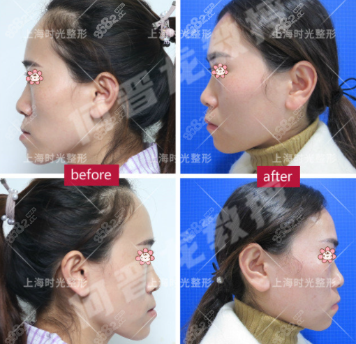 何晉龍正頜手術(shù)矯正地包天實(shí)例效果圖 何晉龍正頜手術(shù)矯正地包天實(shí)例效果圖