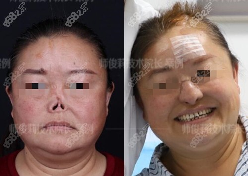 西安国医中心整形医院师俊莉鼻再造术前术后对比