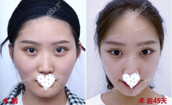 上海時(shí)光整形顴骨內(nèi)推手術(shù)效果圖 上海時(shí)光整形顴骨內(nèi)推手術(shù)效果圖