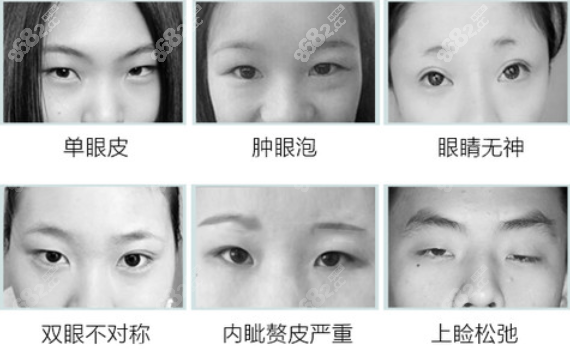 北京领医日式无痕永 久埋线双眼皮可以治疗的眼部缺陷