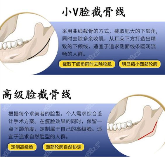 趙絳波磨骨技術(shù)