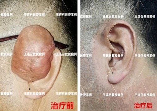 北京八大处王连召疤痕疙瘩术前术后效果图