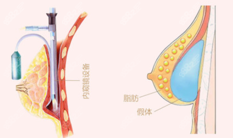 郑州美莱和集美隆胸技术对比