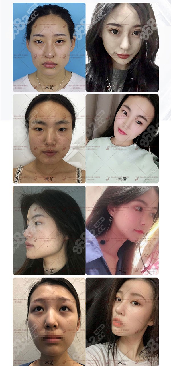 趙絳波醫(yī)生做的下頜角磨骨前后對(duì)比照