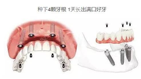 厦门ALL-ON-4满口种植牙技术，4颗牙完成半口种植