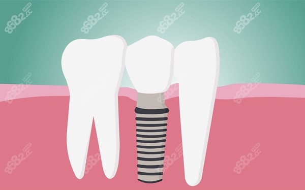 几千块钱的种植牙质量怎么样 几千块钱的种植牙质量怎么样