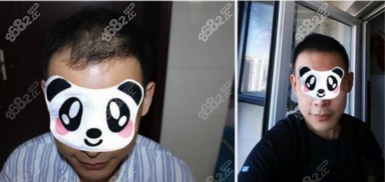 头顶植发效果图