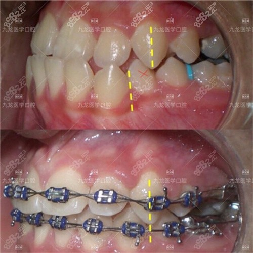 珠海九龙口腔医院金属矫正对比