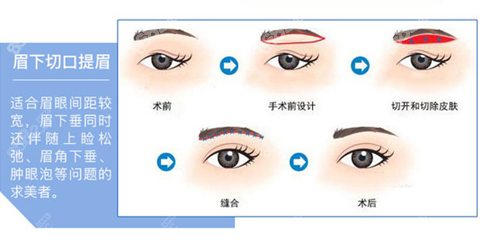 北京百达丽医疗美容门诊部做提眉手术的原理图示
