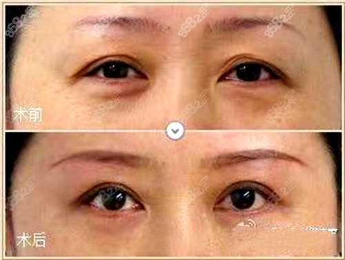 北京圣嘉新医疗美容医院黄海滨切眉术前术后对比图