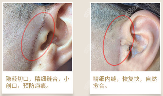 郑州广运小切口拉皮耳前疤痕图片