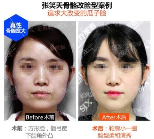 北京张笑天磨骨改脸型真人对比照